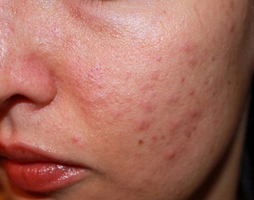 DA BỊ KÍCH ỨNG MỸ PHẨM CẦN ĐƯỢC LÀM SẠCH VÀ DƯỠNG ẨM NHẸ NHÀNG